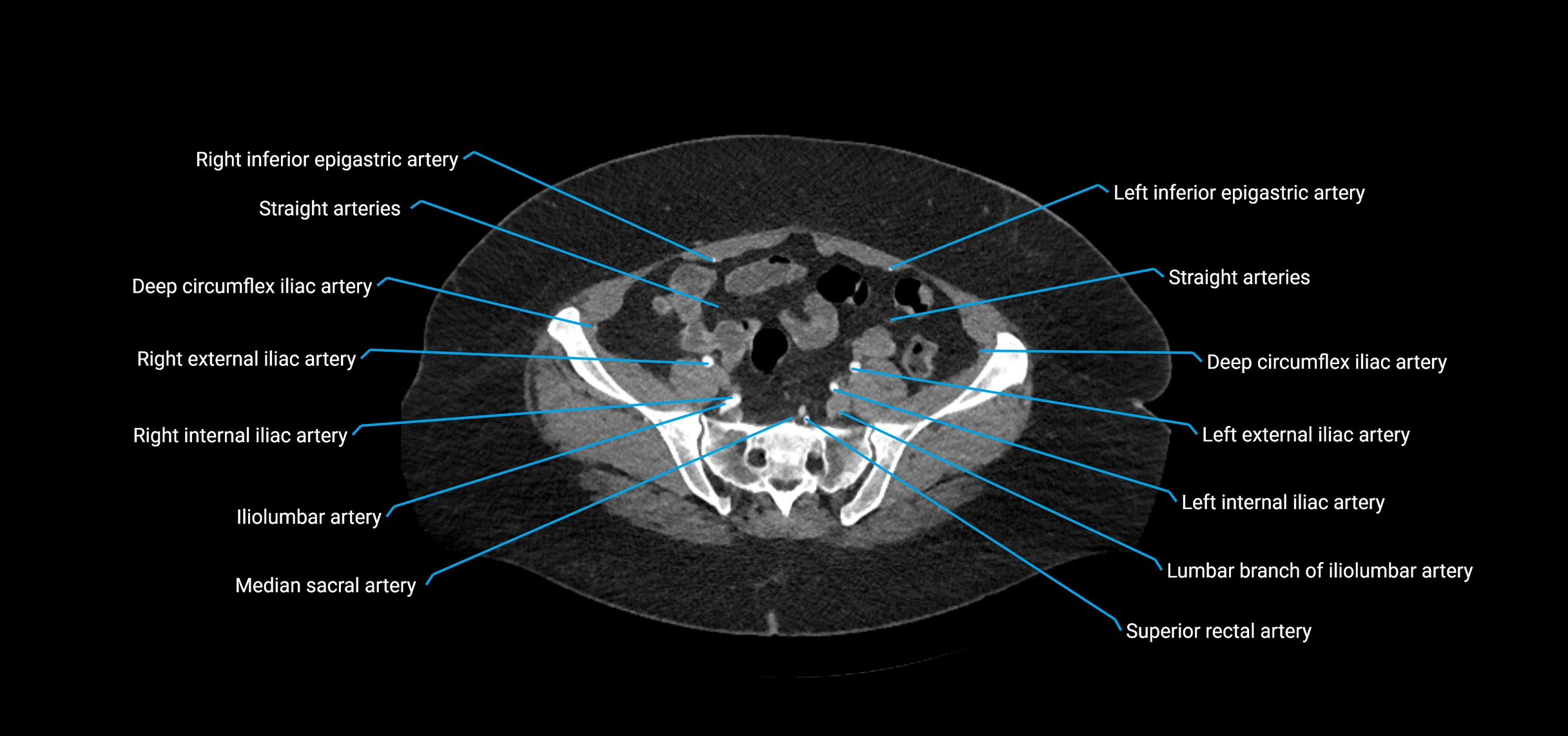 CTA abdomen axial cross sectional anatomy labelled image_192 (2).webp